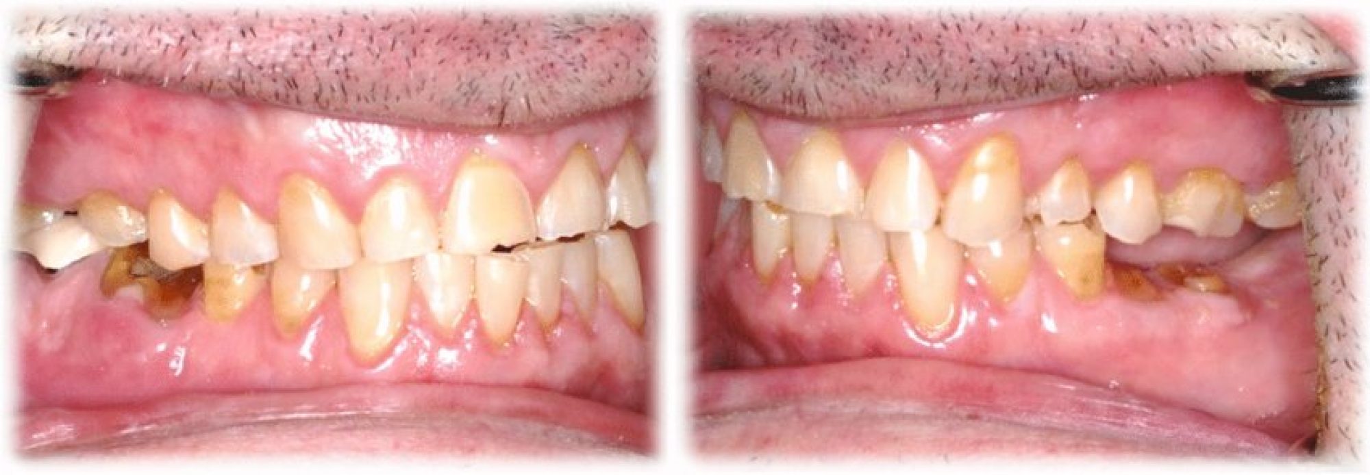 Loss-of-VDO-due-to-missing-and-severely-worn-posterior-teeth